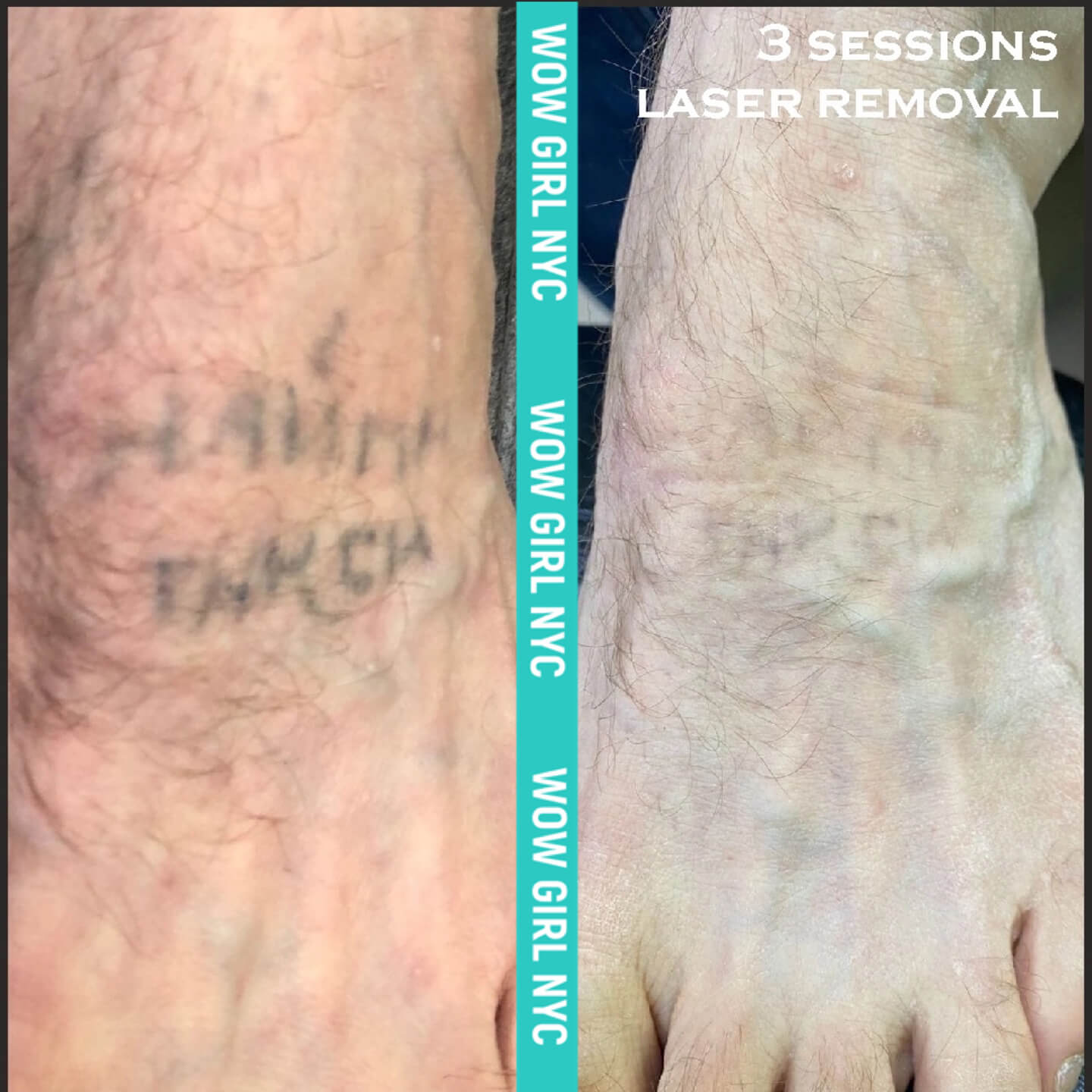 faded tattoo after laser removal New York