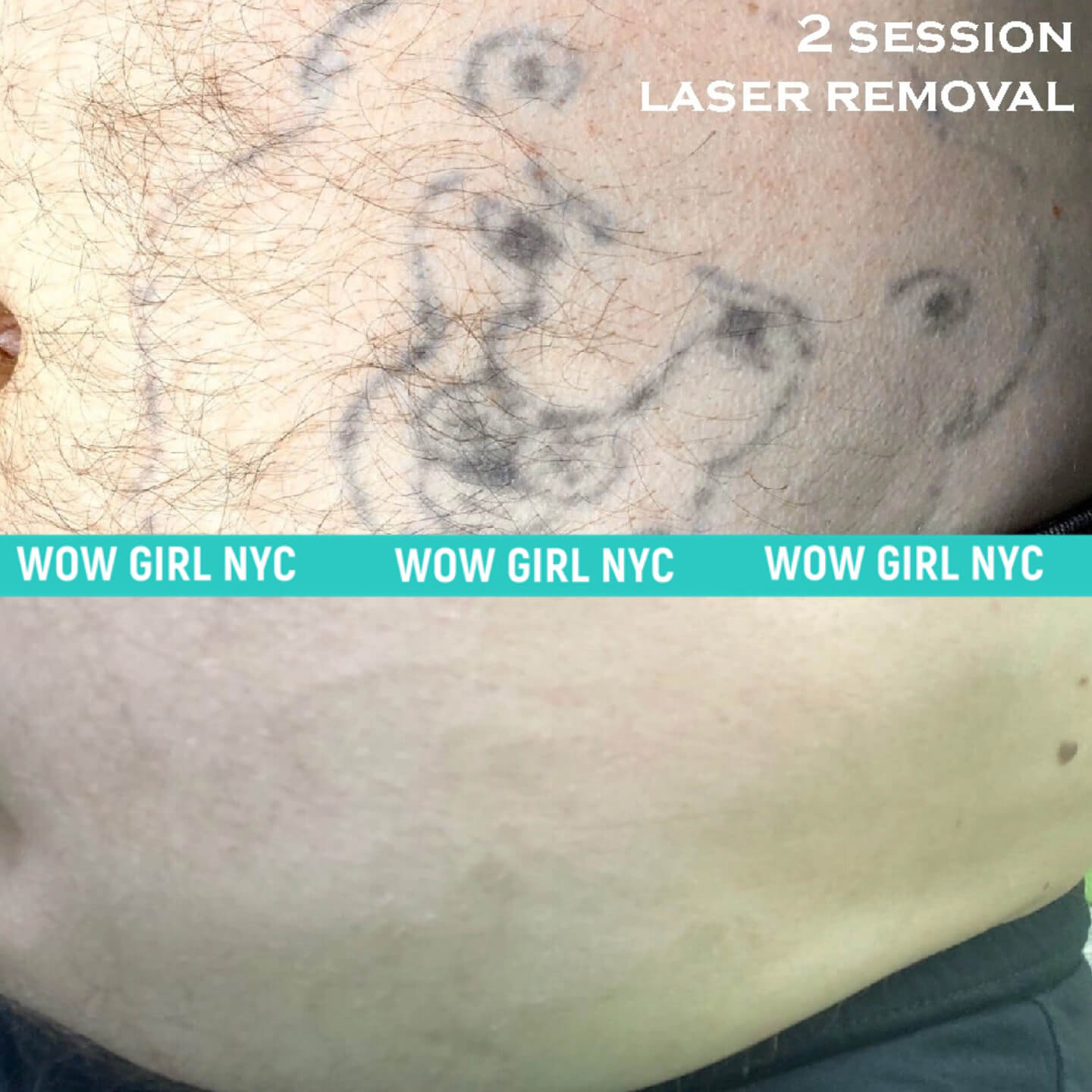 faded tattoo after laser removal New York