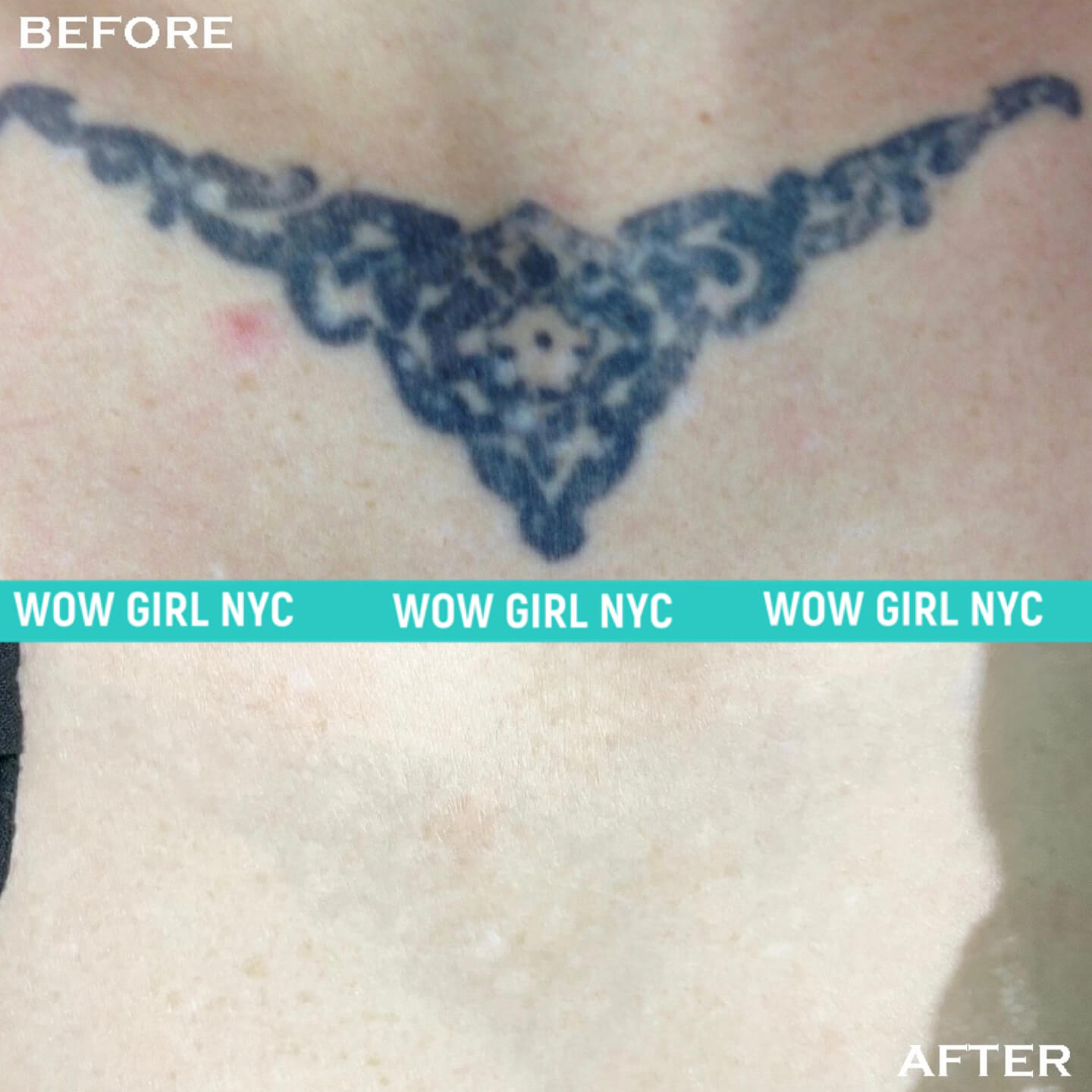 successful tattoo removal before and after NYC