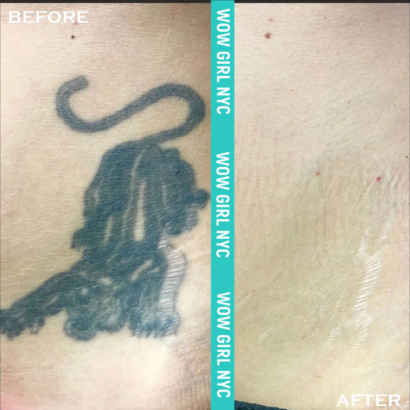 laser removal of arm tattoo results New York