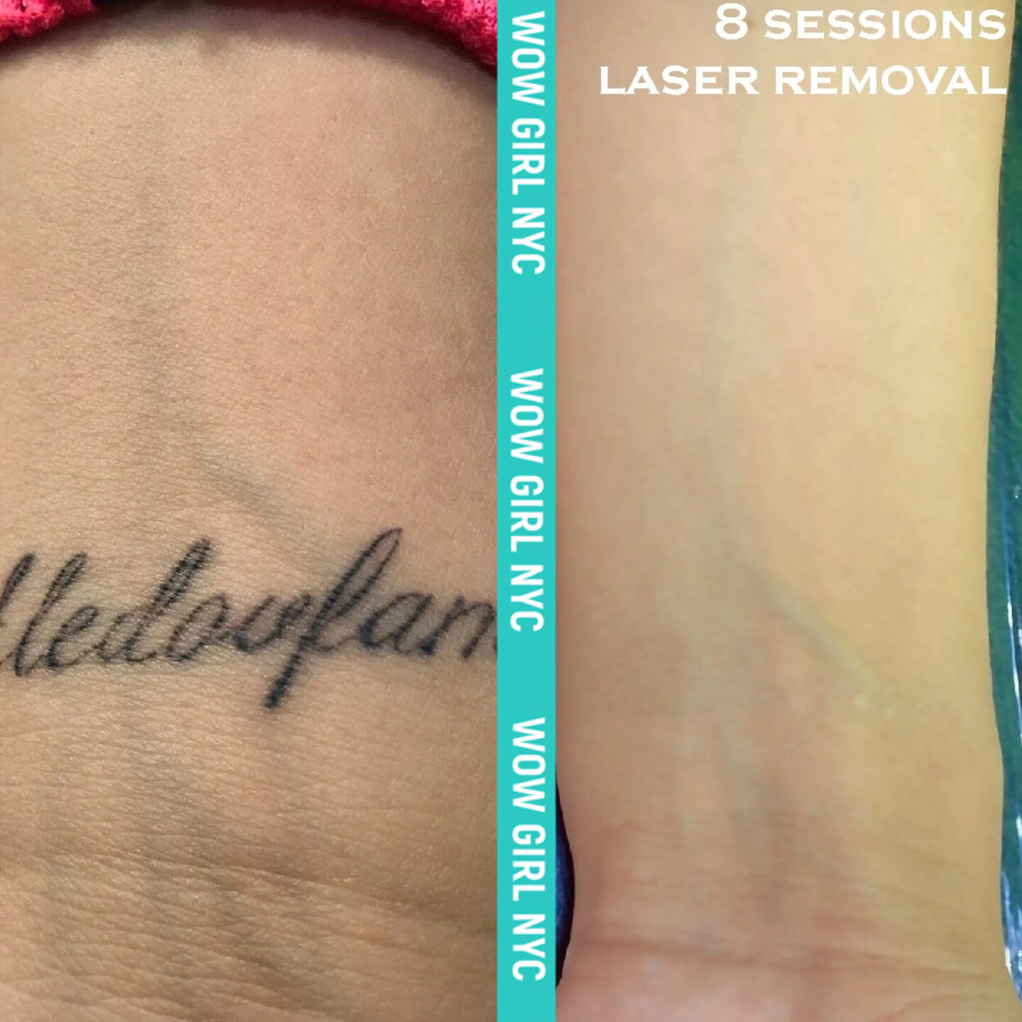 successful tattoo removal before and after NYC