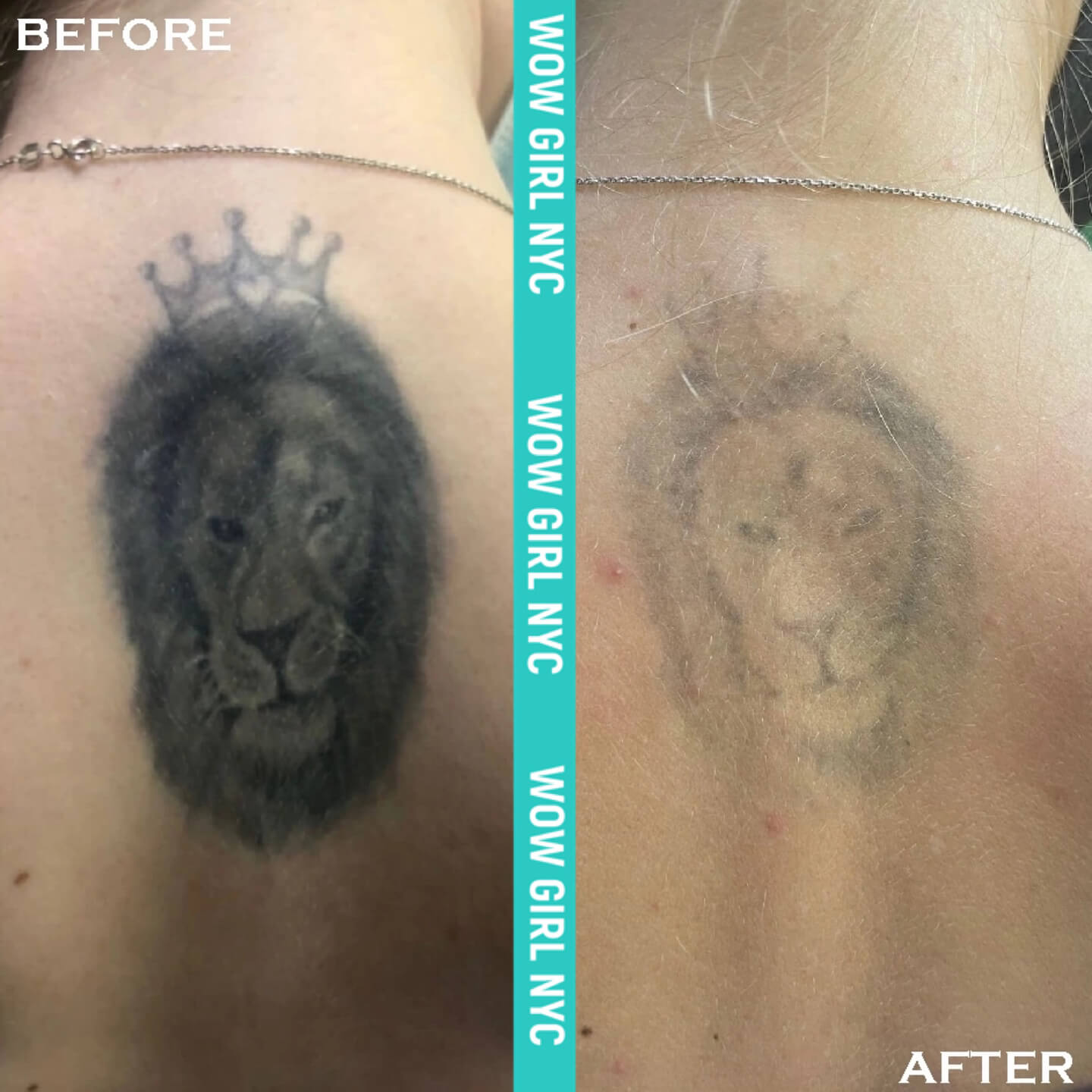 successful tattoo removal before and after NYC