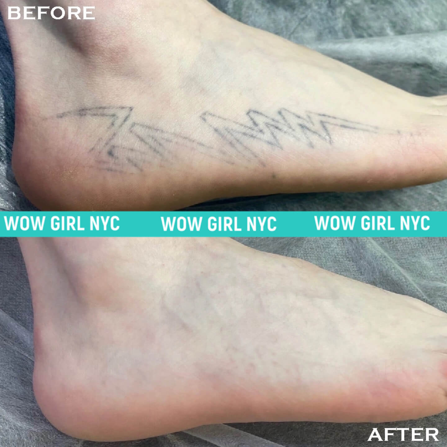 small tattoo removal results NYC