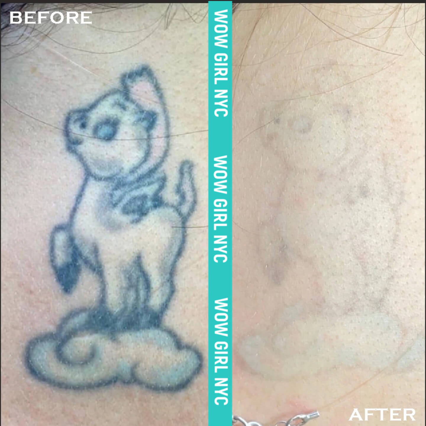 small tattoo removal results NYC