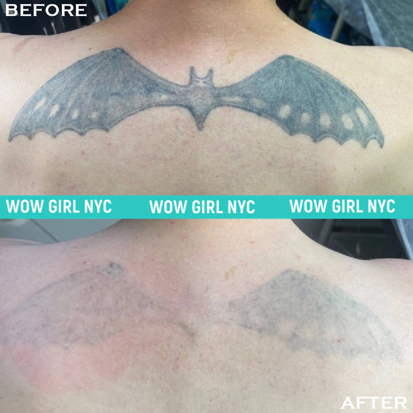 black ink tattoo removal before after New York