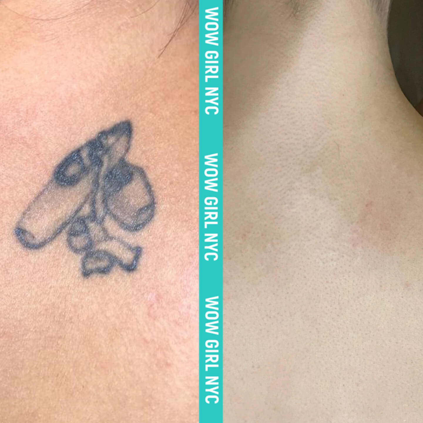 black ink tattoo removal before after New York