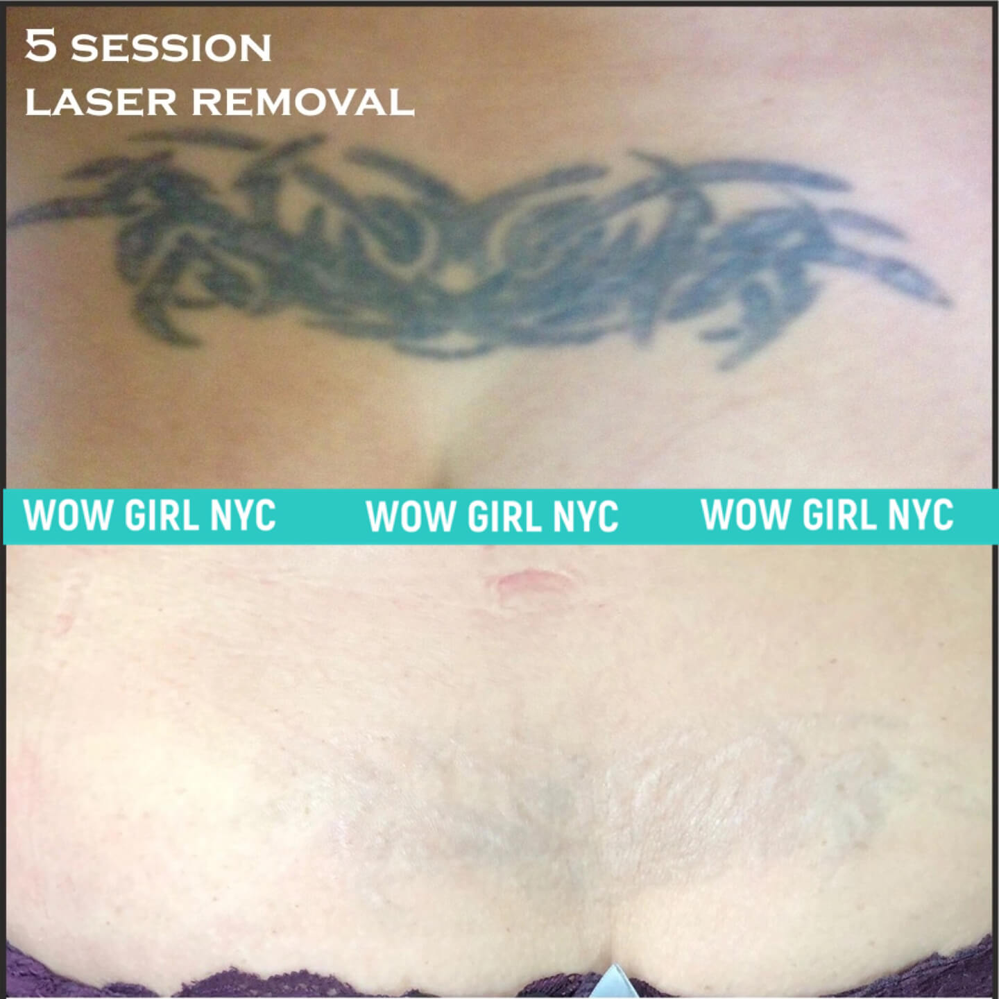 black ink tattoo removal before after New York