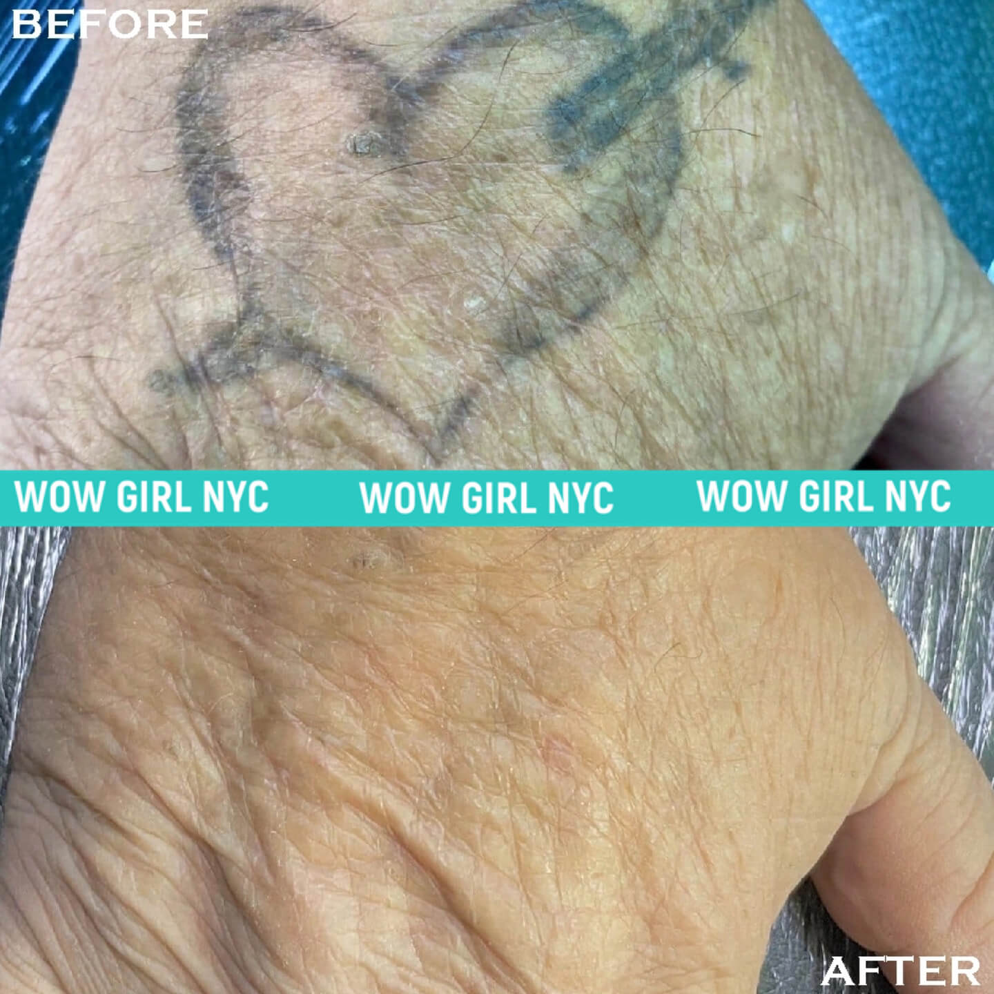 laser removal of arm tattoo results New York
