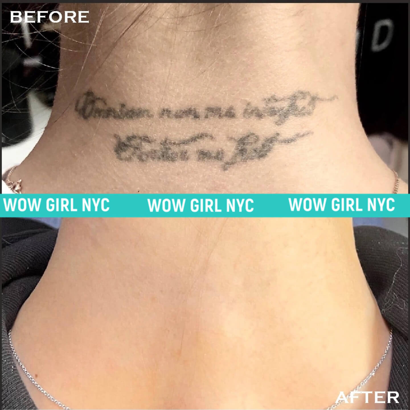 black ink tattoo removal before after New York
