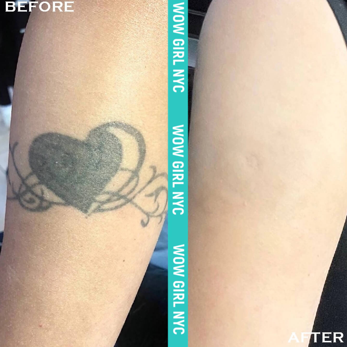 black ink tattoo removal before after New York