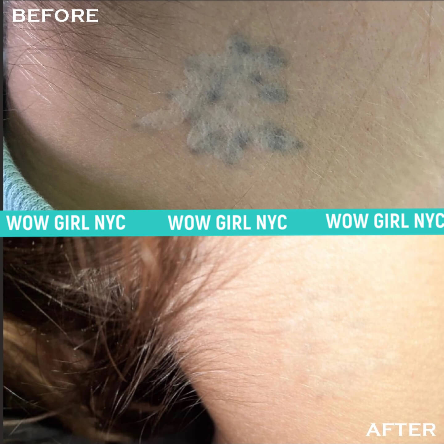 before and after laser tattoo removal NYC results
