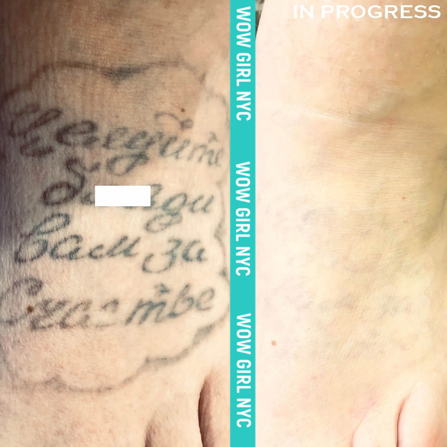 before and after laser tattoo removal NYC results