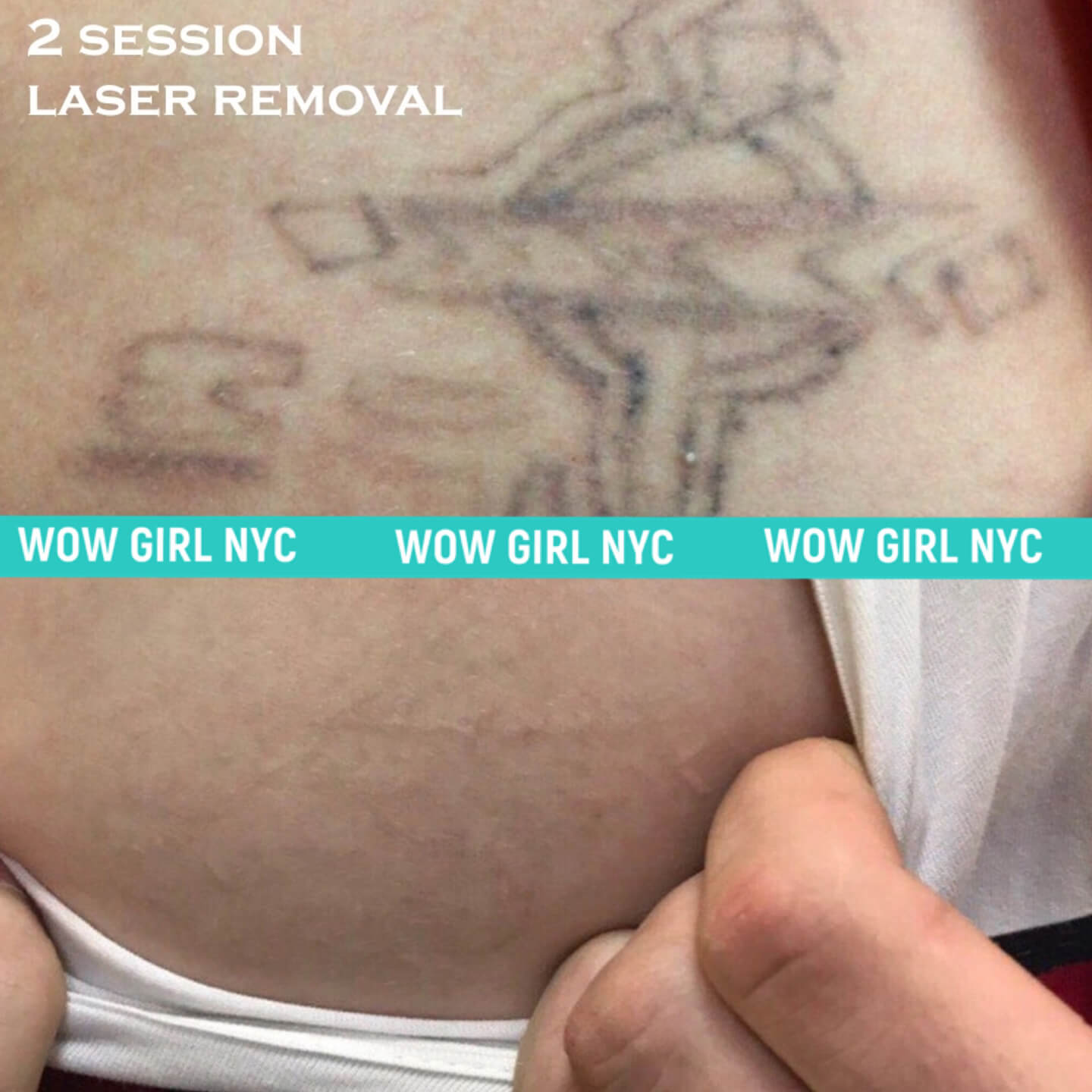 before and after laser tattoo removal NYC results