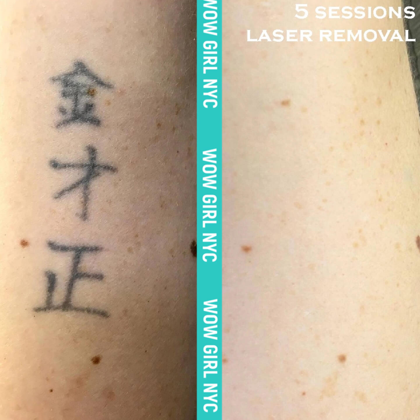 before and after laser tattoo removal NYC results