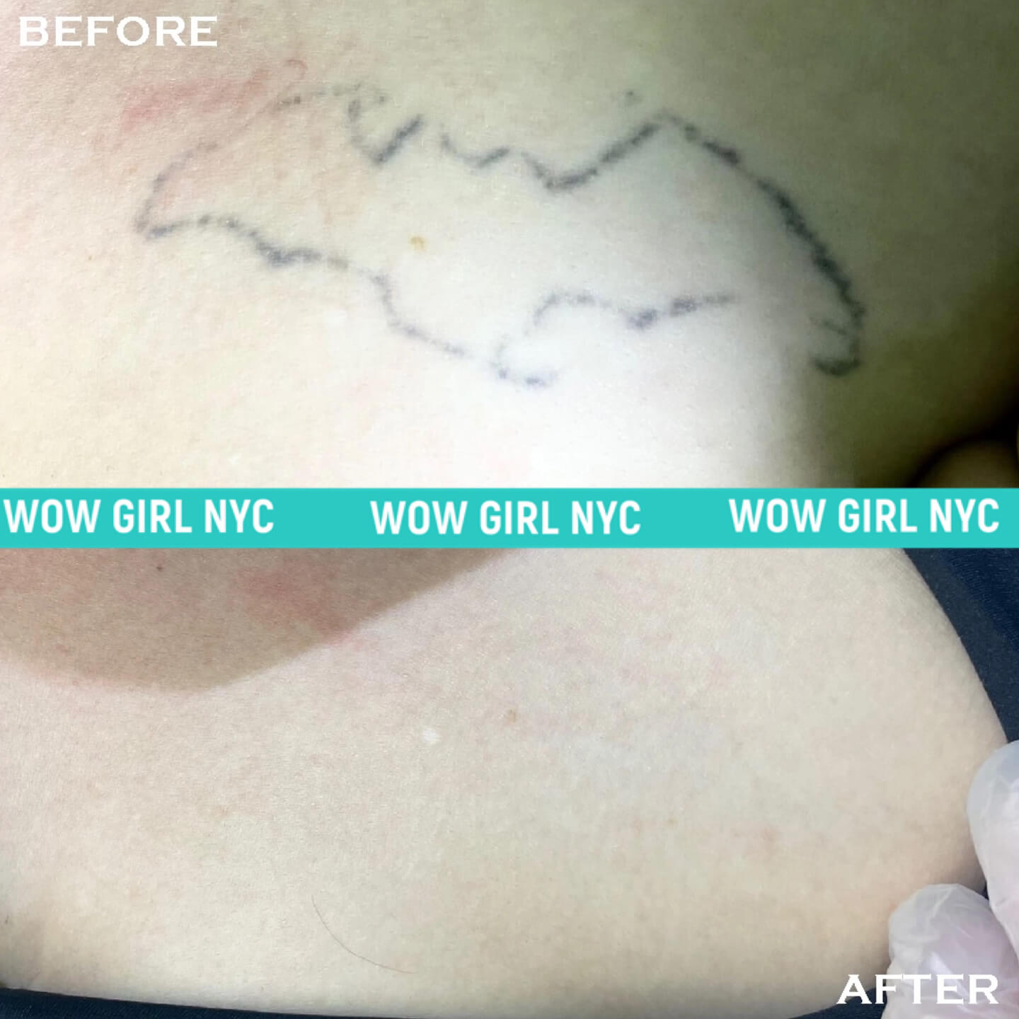 tattoo removal before after New York