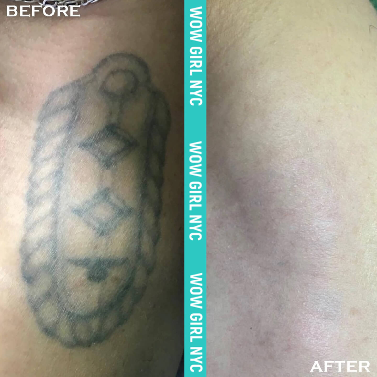 tattoo removal before after New York