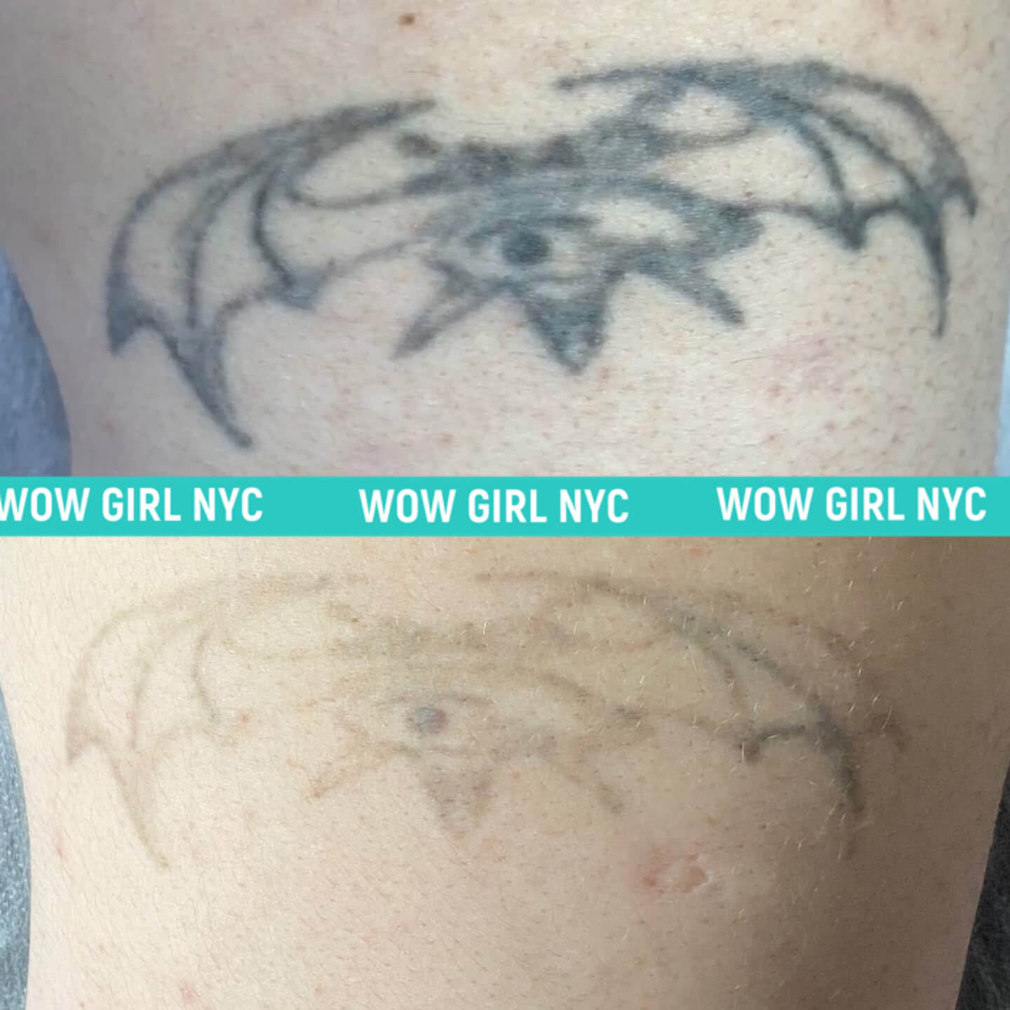 tattoo removal before after New York
