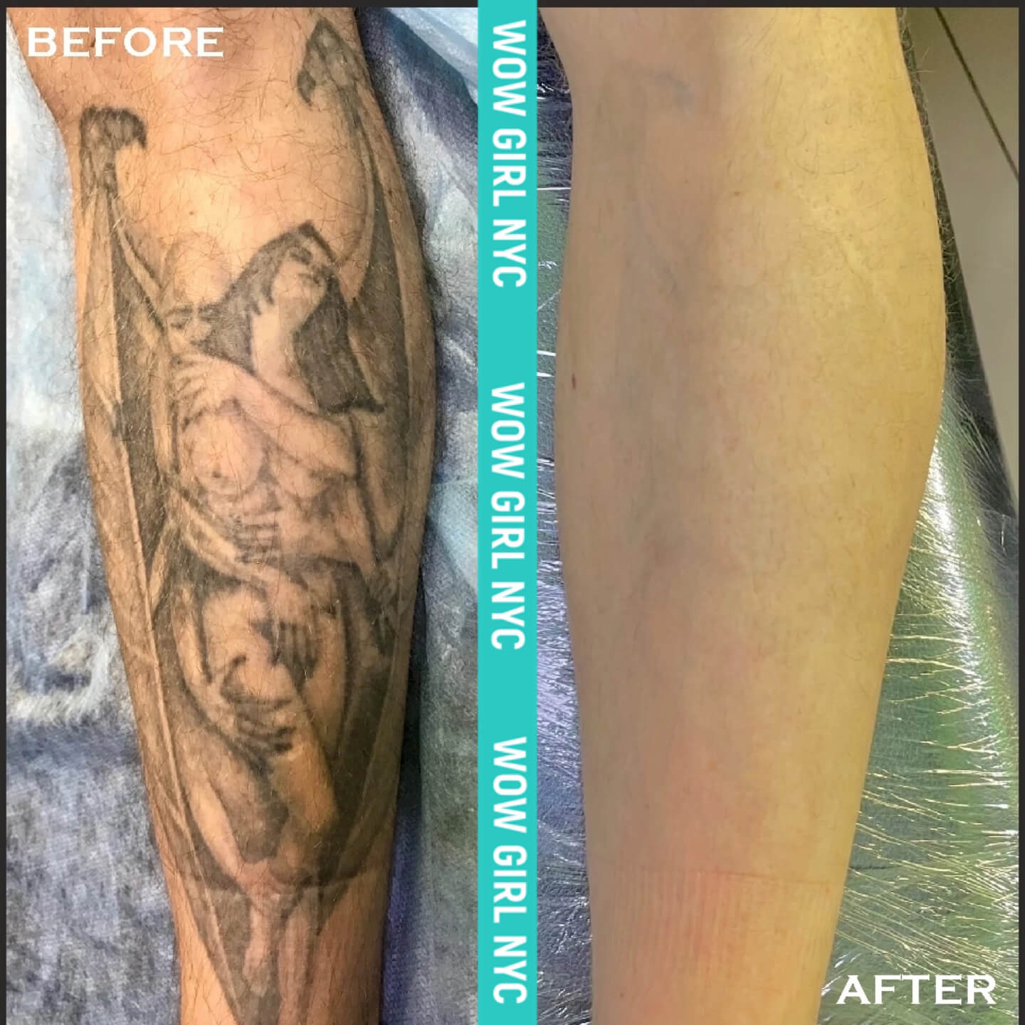 laser removal of arm tattoo results New York