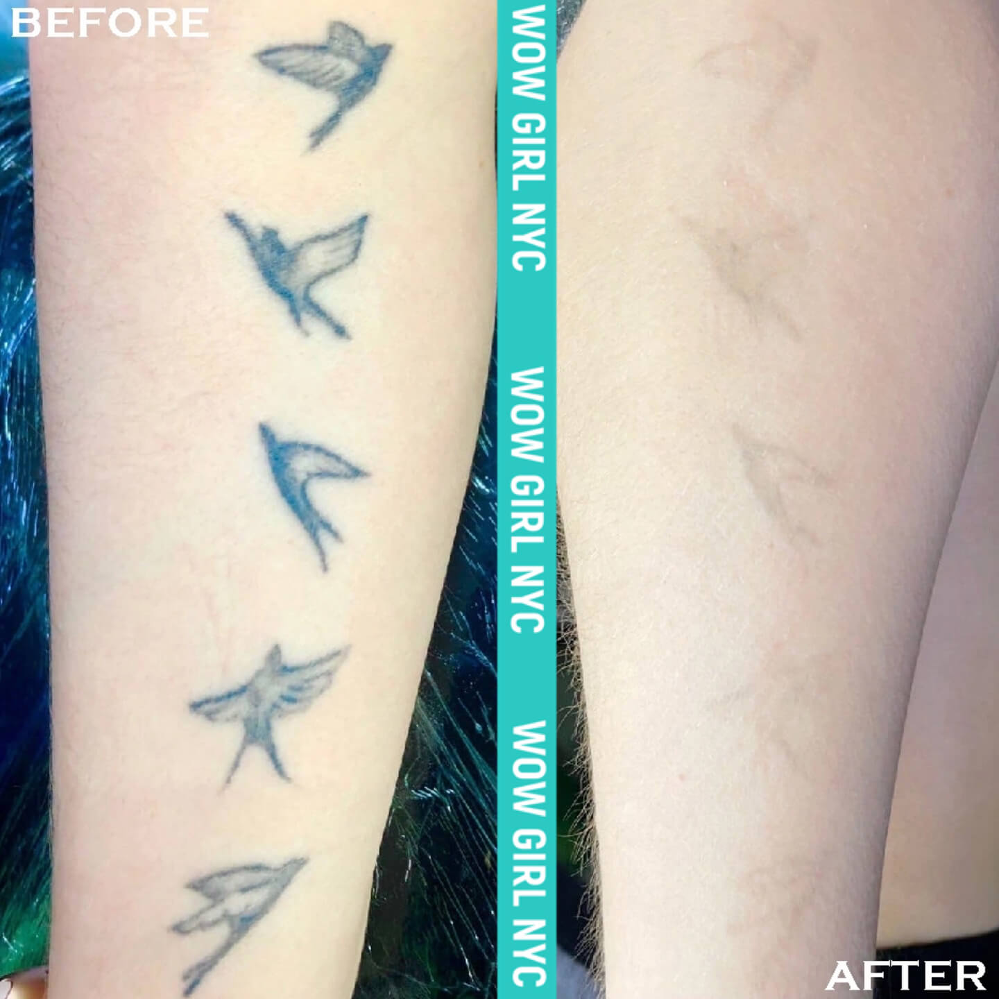 tattoo removal before after New York