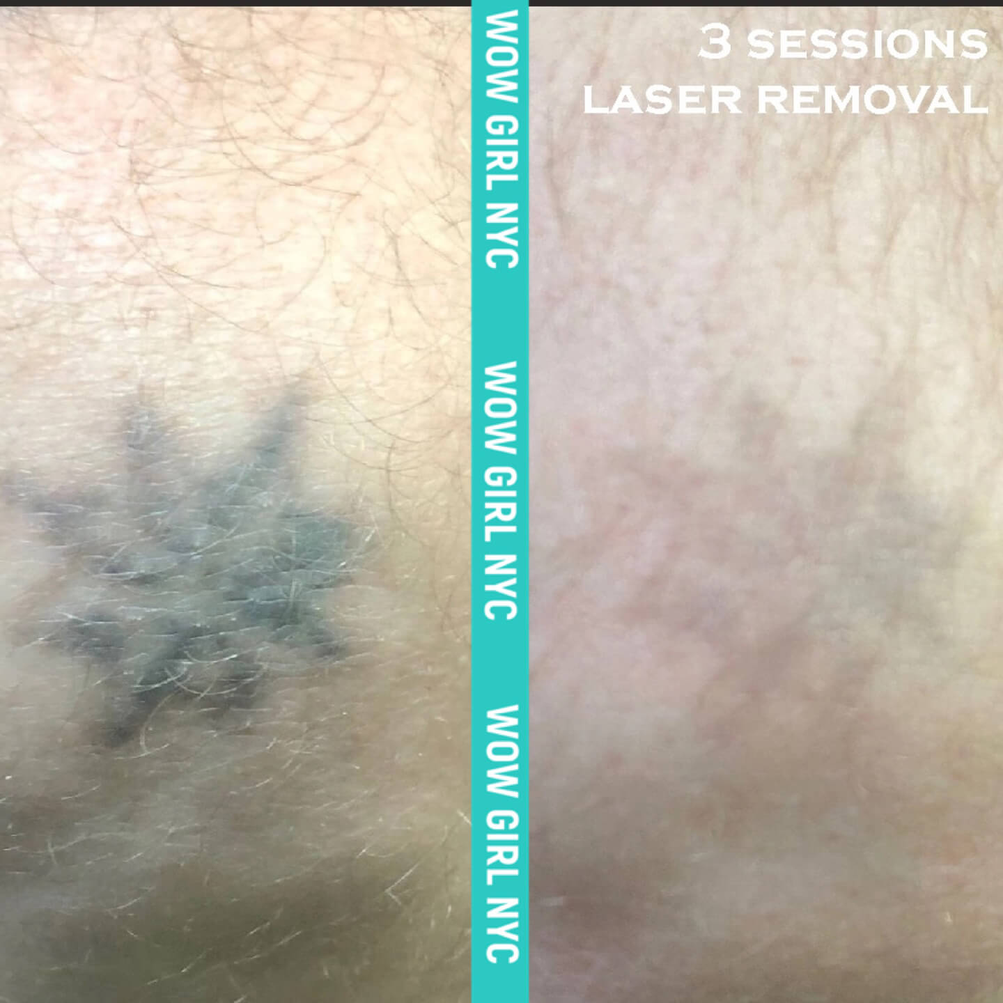 tattoo removal before after New York