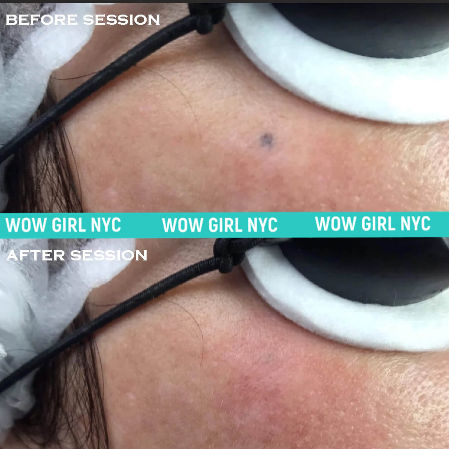 laser tattoo removal results New York