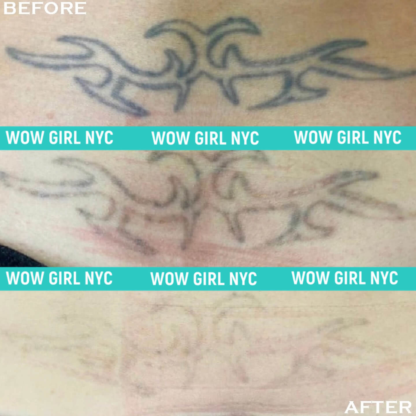 laser tattoo removal results New York