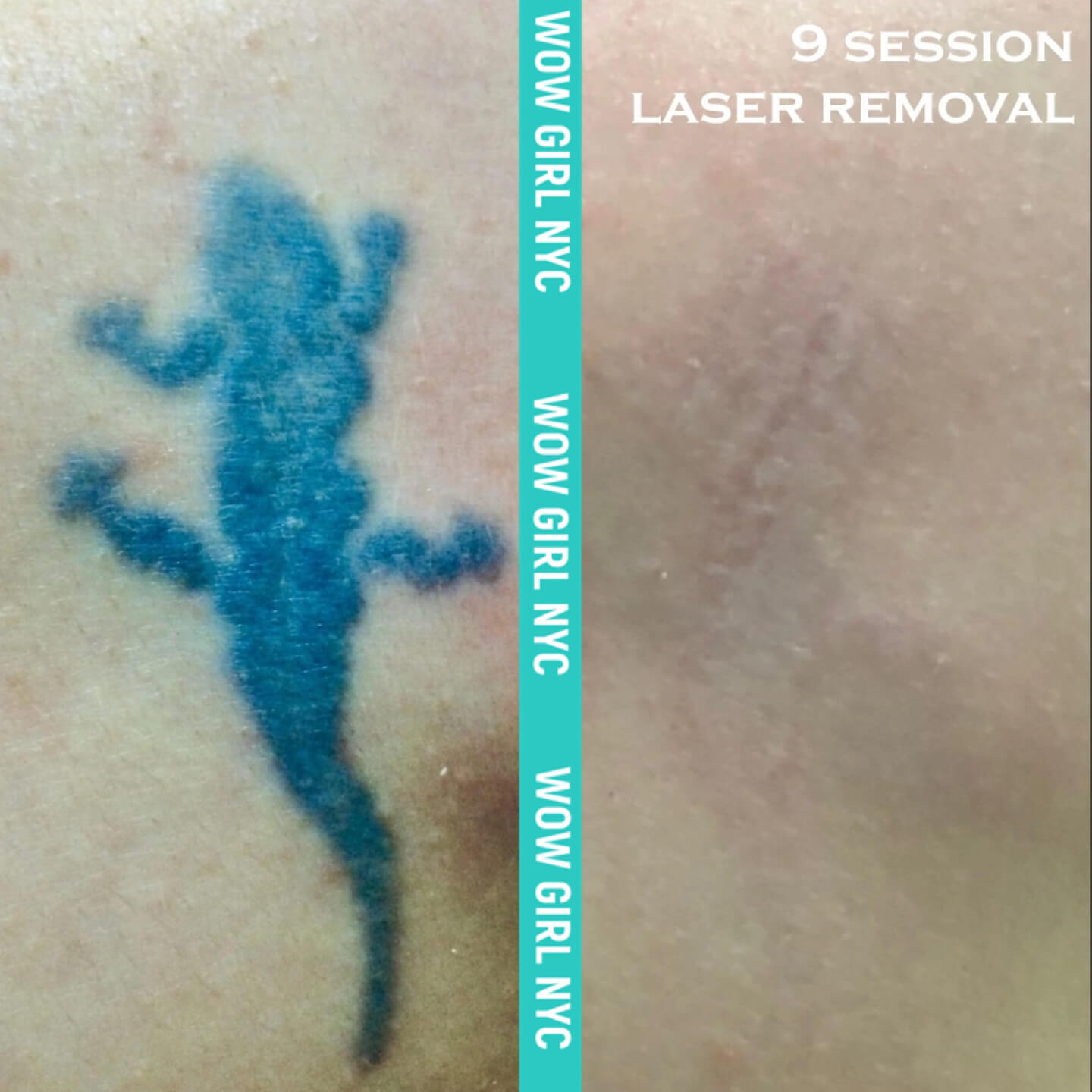 laser tattoo removal results New York