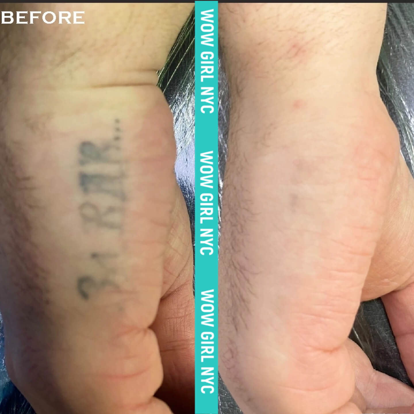 laser tattoo removal results New York