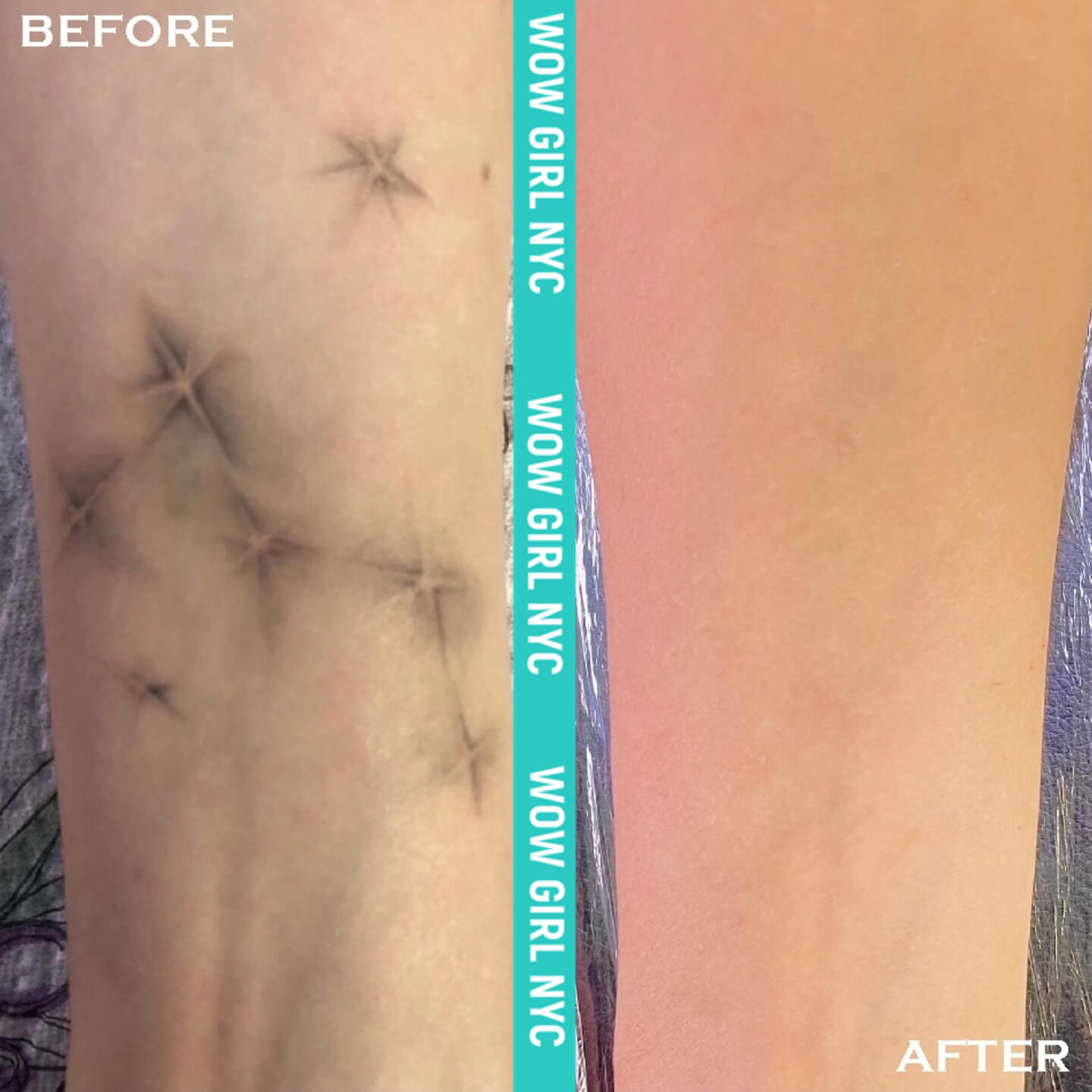laser tattoo removal results New York