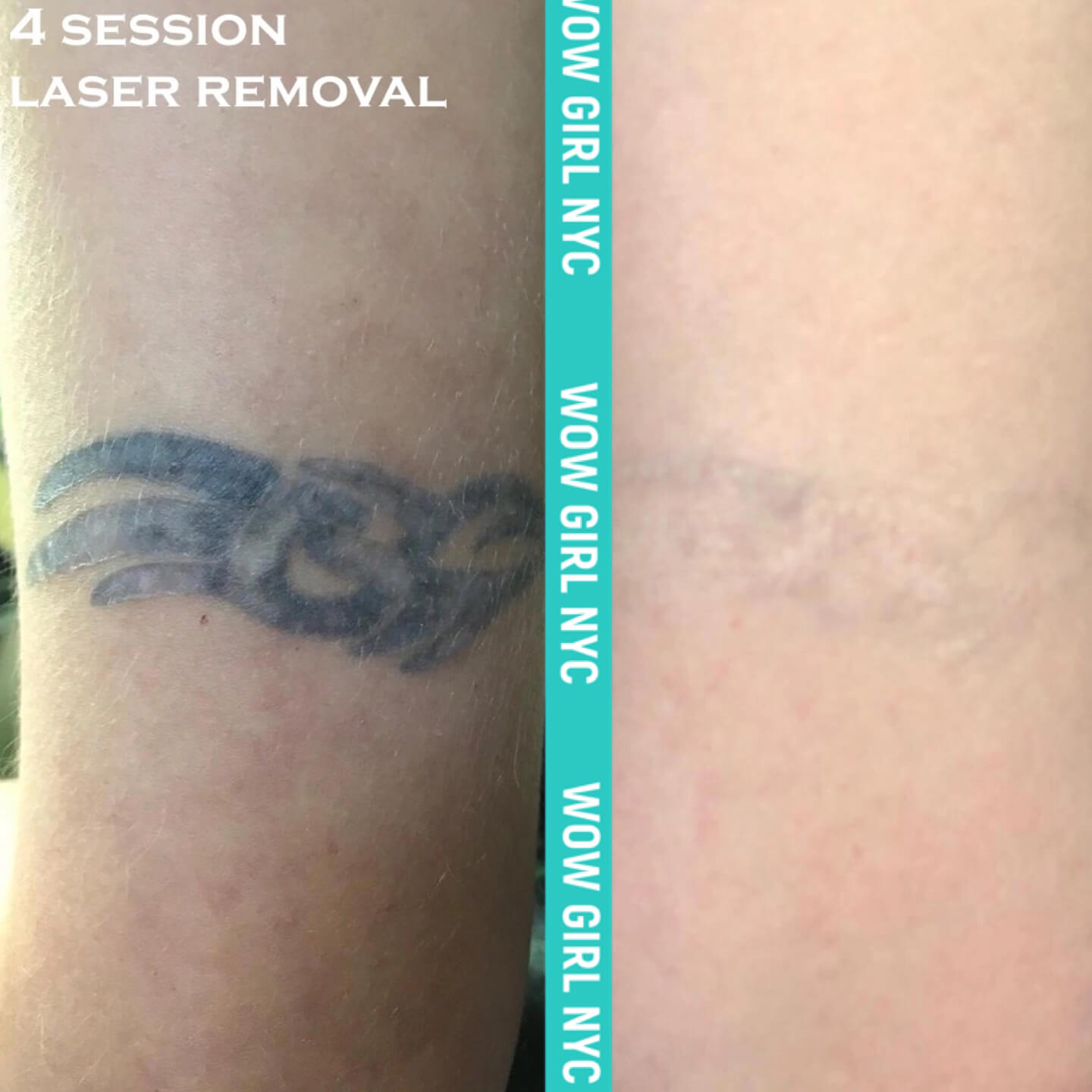 laser tattoo removal results New York
