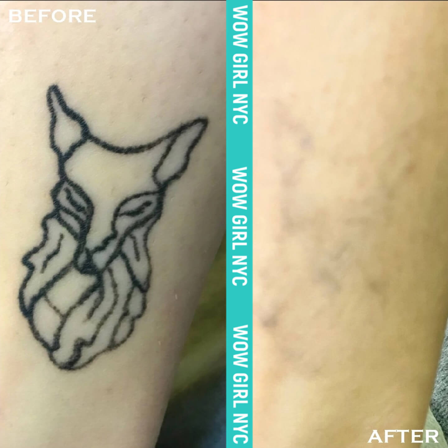 tattoo removal before and after NYC