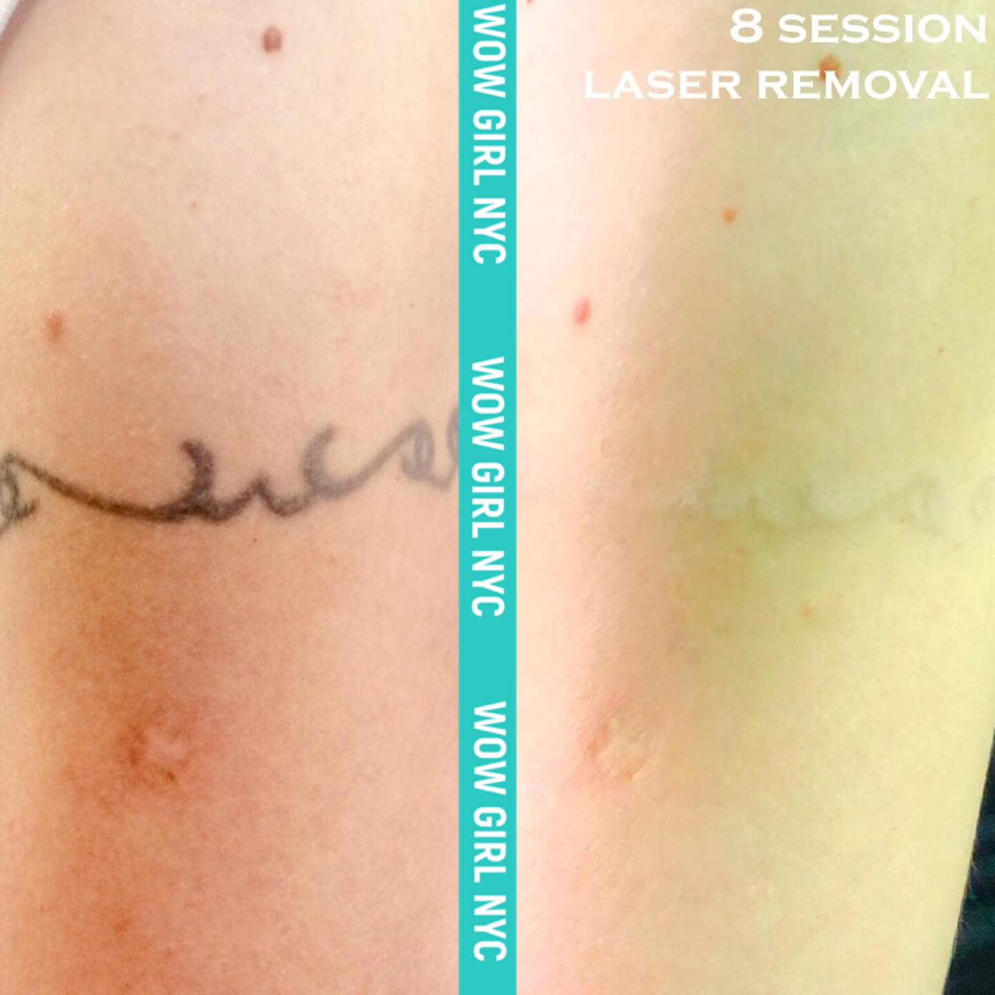 tattoo removal before and after NYC