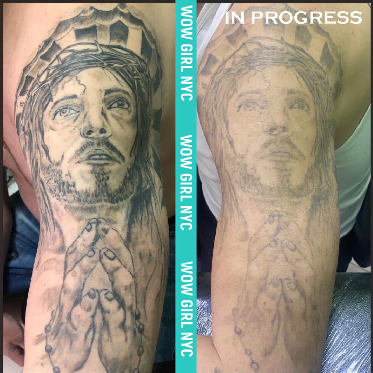 laser removal of arm tattoo results New York