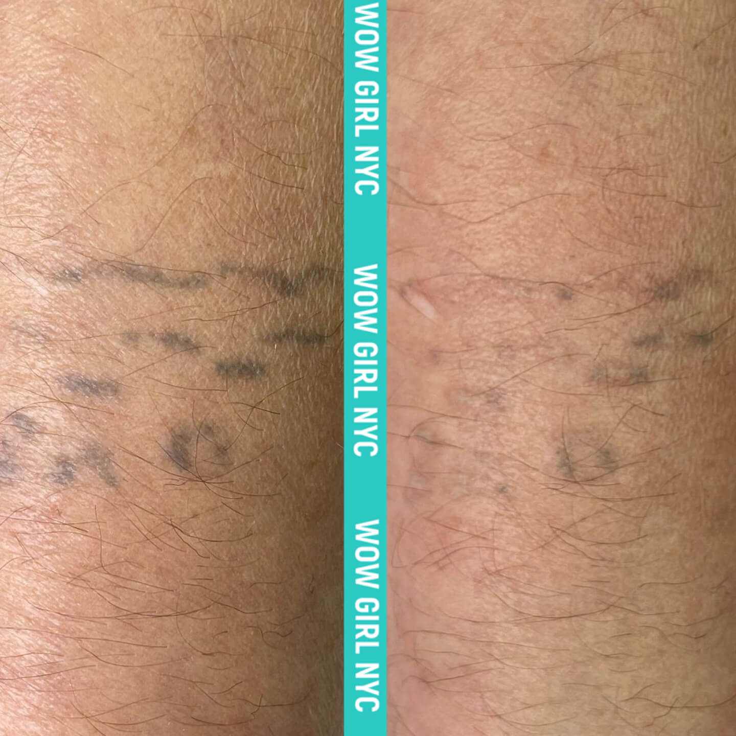 tattoo removal before and after NYC