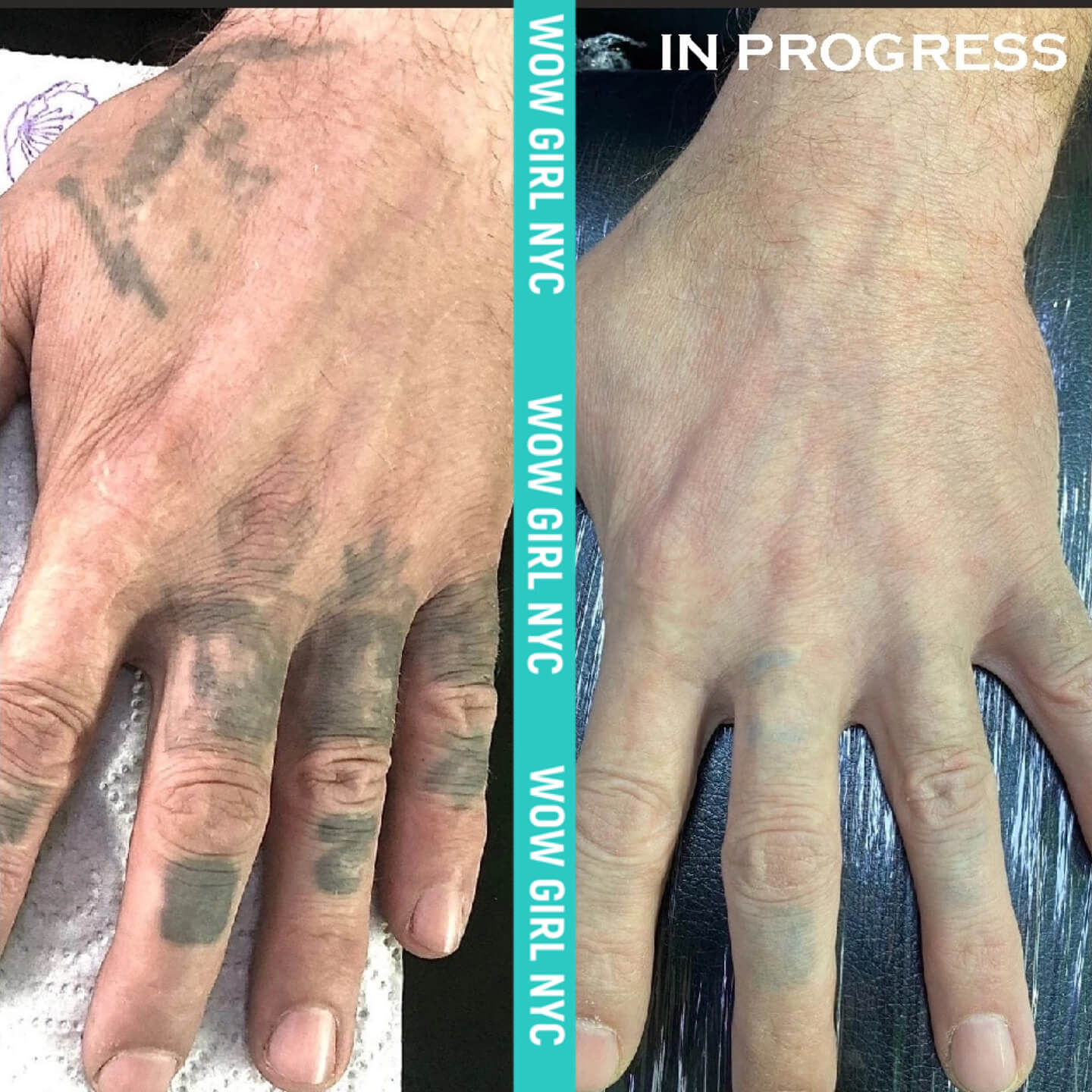 tattoo removal before and after NYC
