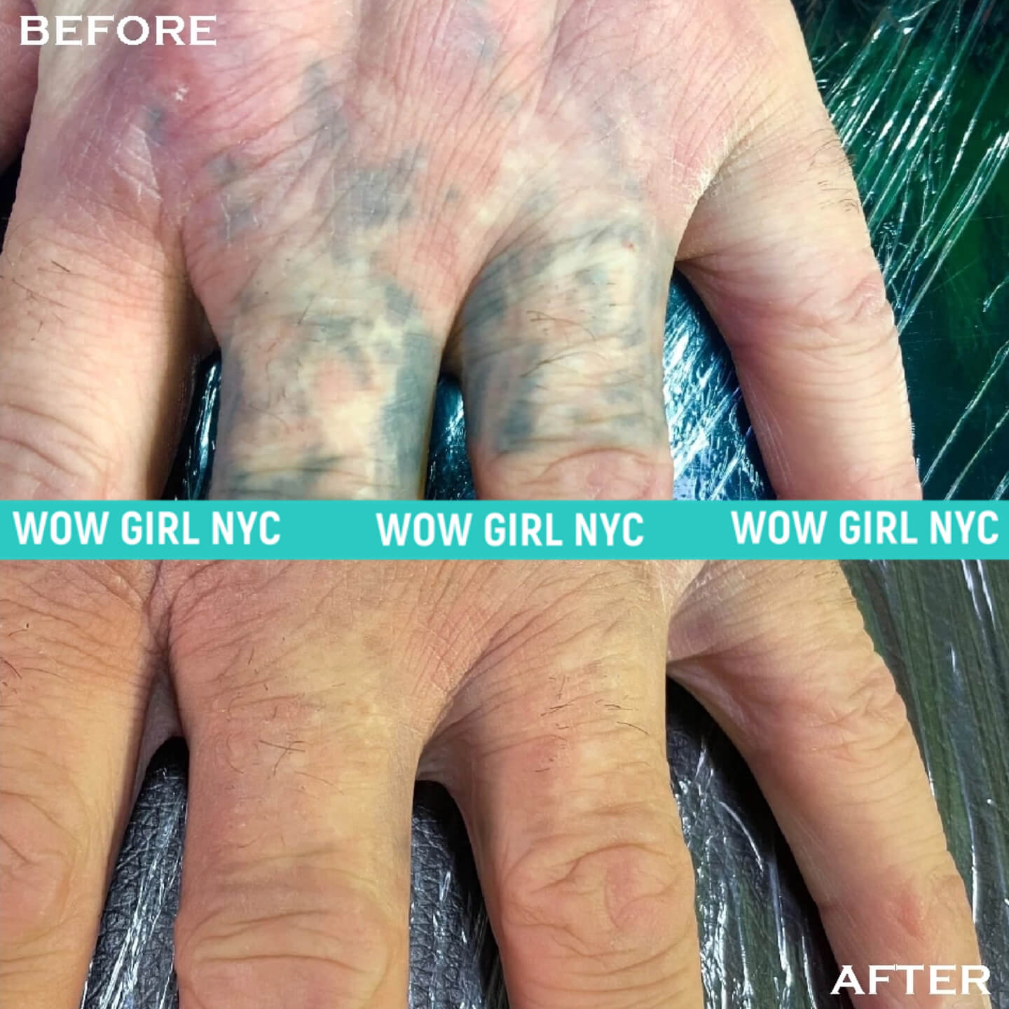 tattoo removal before and after NYC