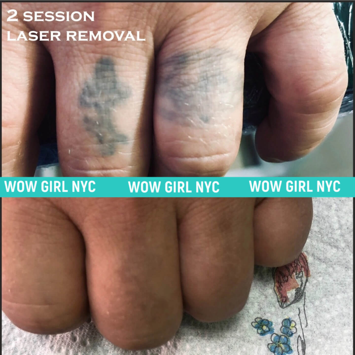 tattoo removal before after New York