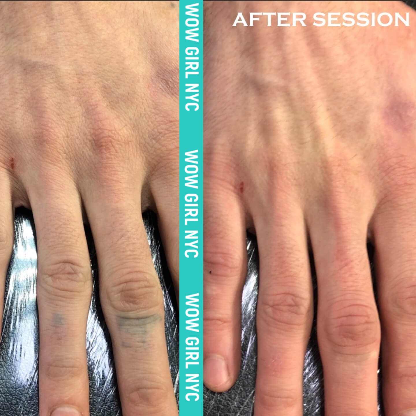 tattoo removal before after New York