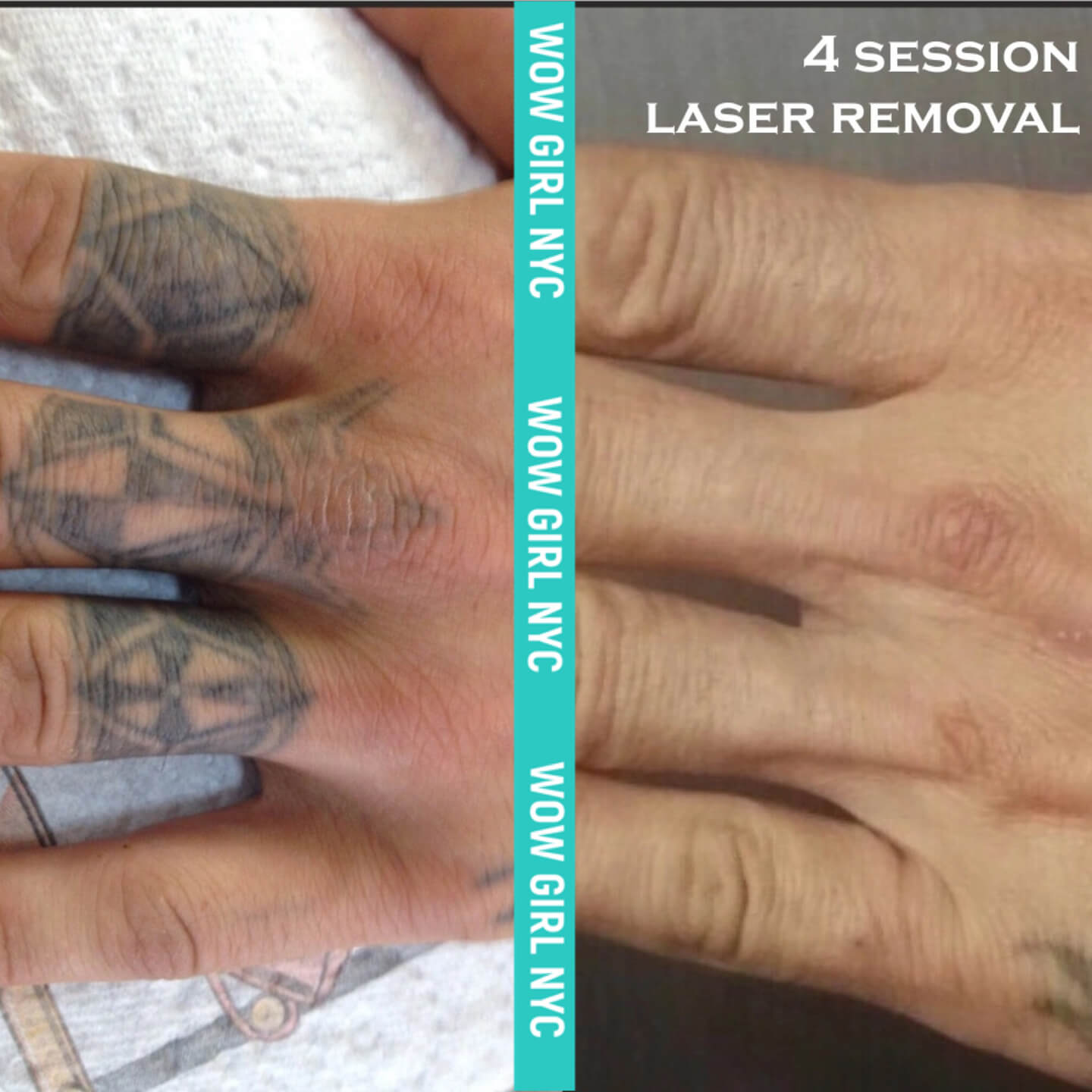 tattoo removal before after New York
