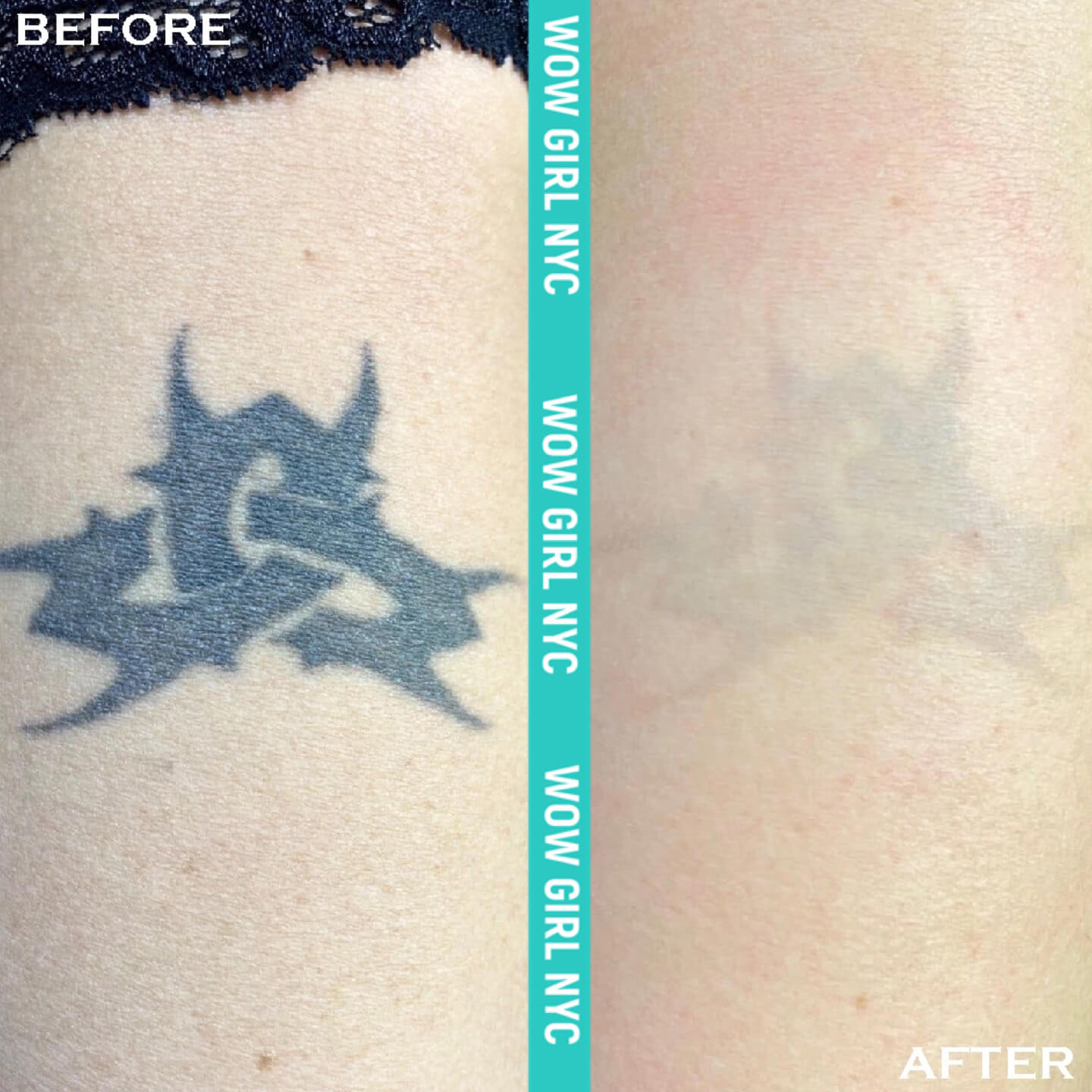 laser removal of arm tattoo results New York