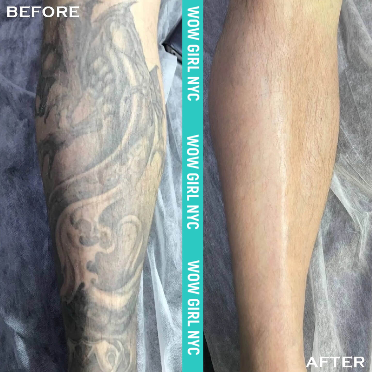 laser removal of arm tattoo results New York